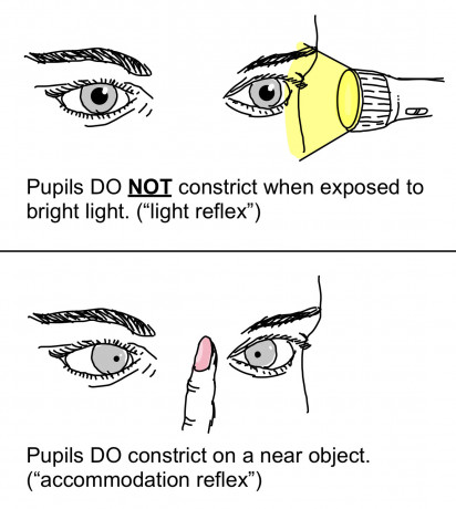 Pupil Abnormalities - PREP Duke Elder