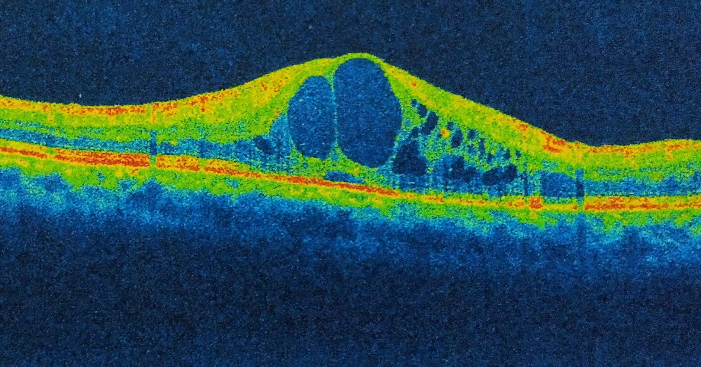 Acquired Macular Disease - PREP Duke Elder