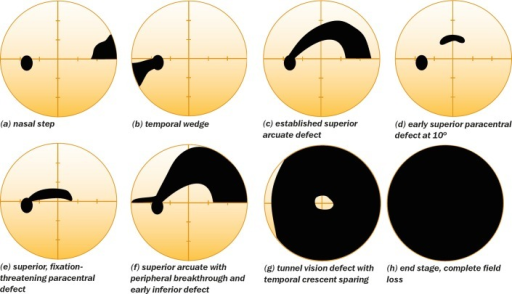 Principles of Glaucoma - PREP Duke Elder