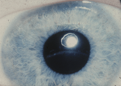 ectopic pupil