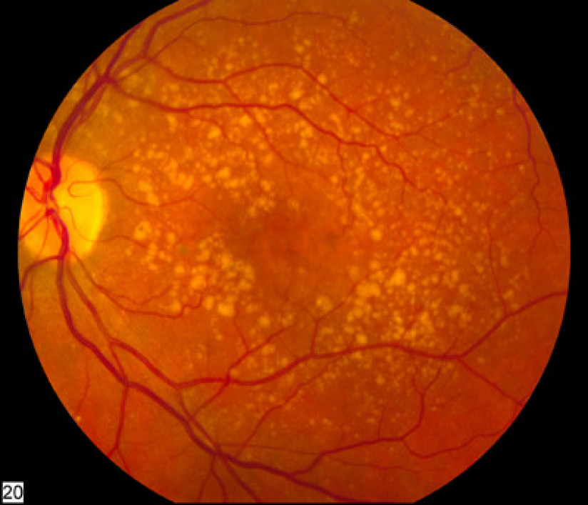 Acquired Macular Disease - PREP Duke Elder